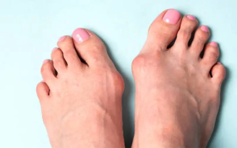 Bunion Treatment