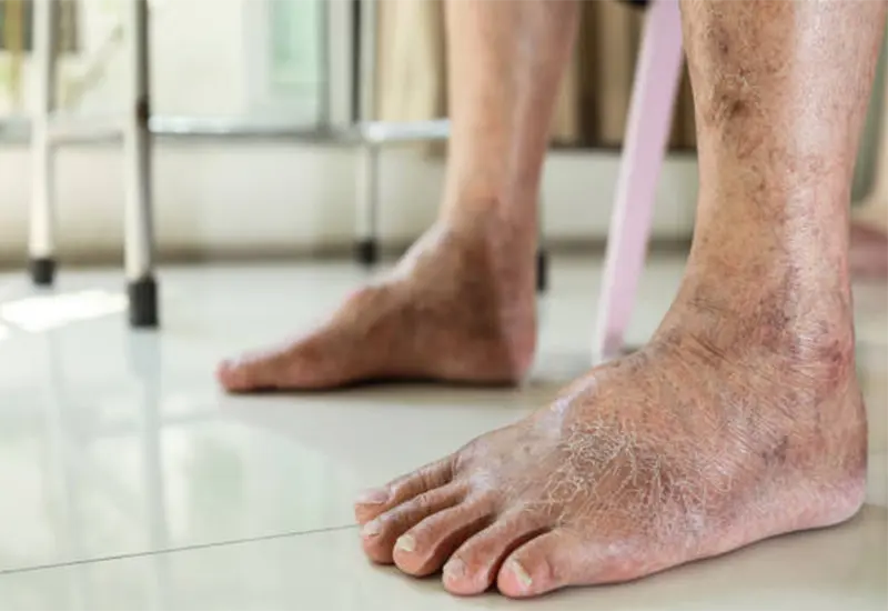 In people with PAD, walking at uncomfortable pace may improve mobility