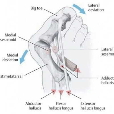 Internal diagram of a bunion on the right foot