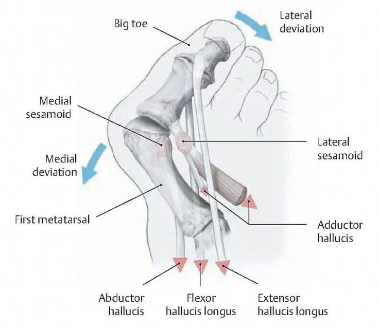 Internal diagram of a bunion on the right foot