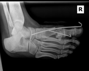 An x-ray of the minimally invasive tools used in MIS.