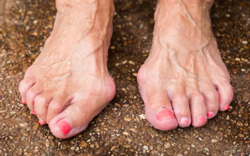 Claw Toe Treatment